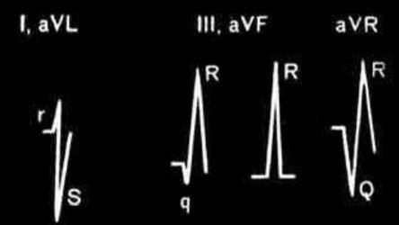 Left Posterior Fascicular Block Beat (Rare) - (BBLP) - Support Center